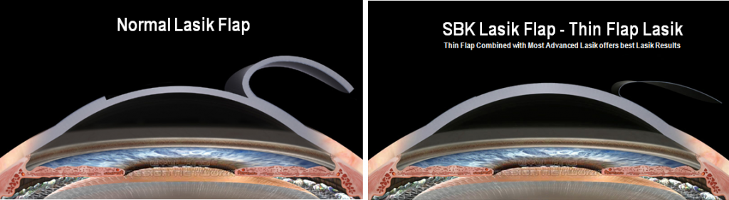 SBK Lasik Surgery